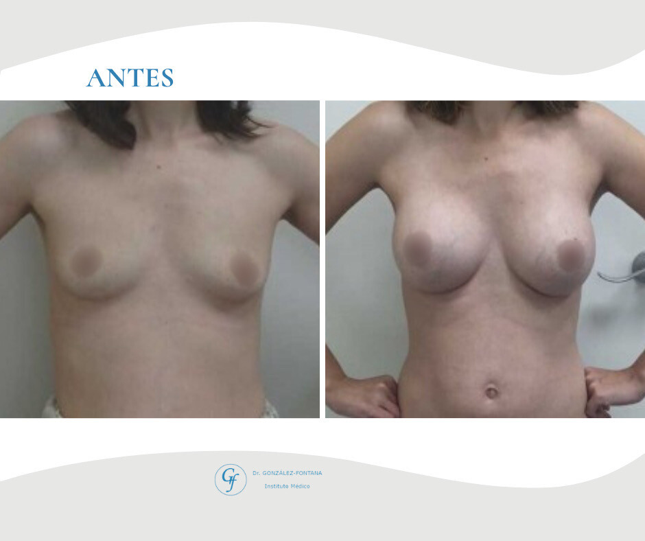 Before and After Result